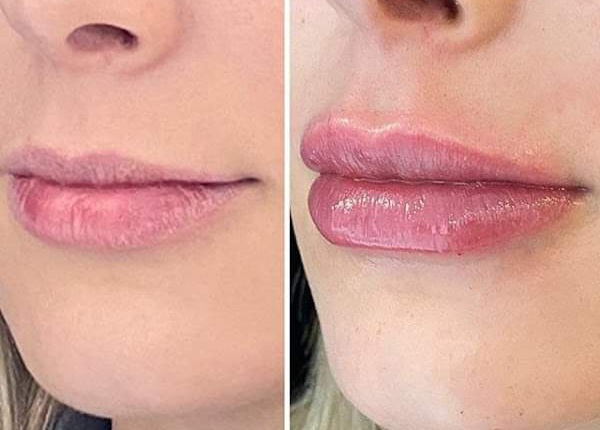 À Saint-Denis | Russian Lips et comblement des rides du sourire  | Les meilleures esthéticiennes