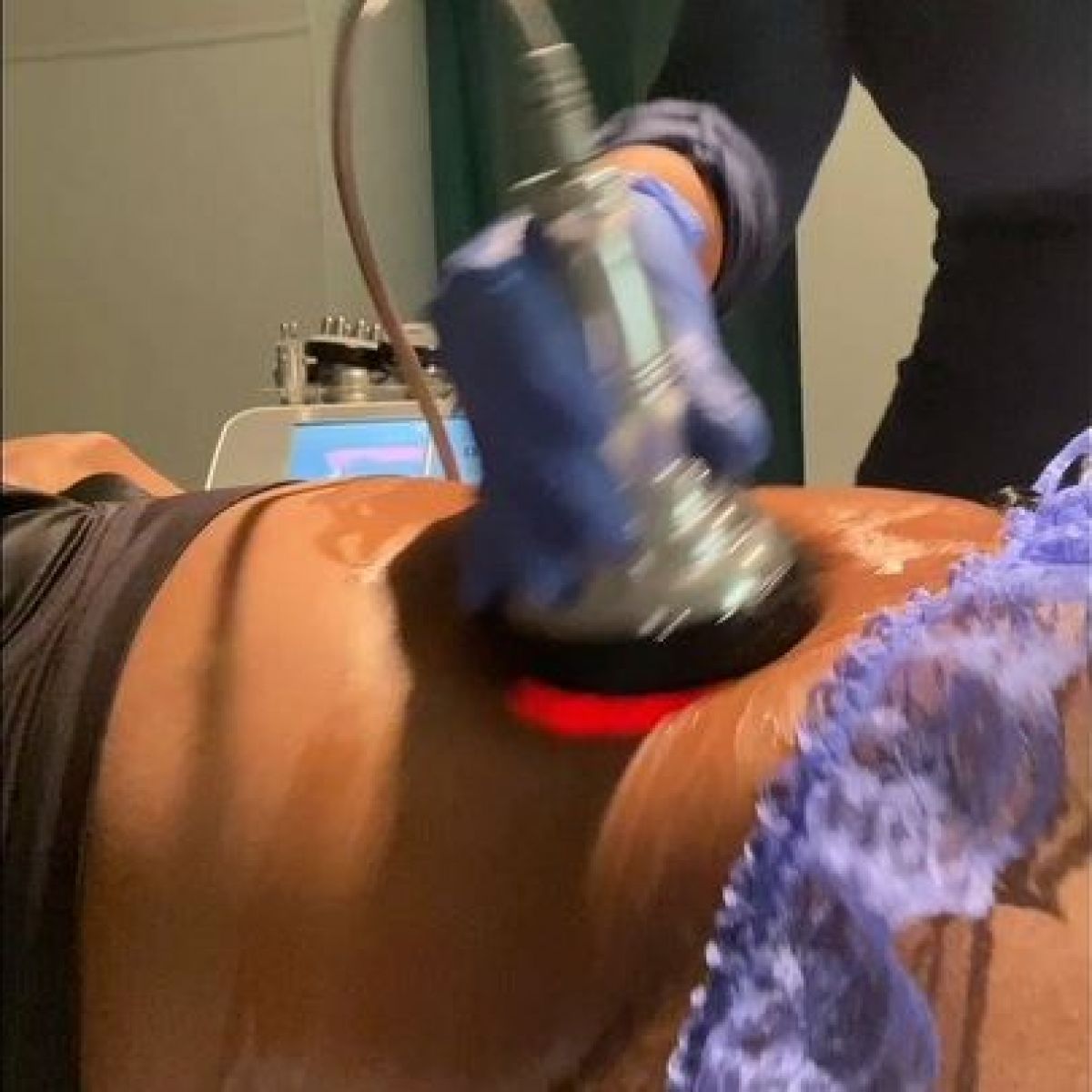 Radio fréquence / Lipocavitation à Saint-Laurent-du-Var (06) Par Adeline - Estheca