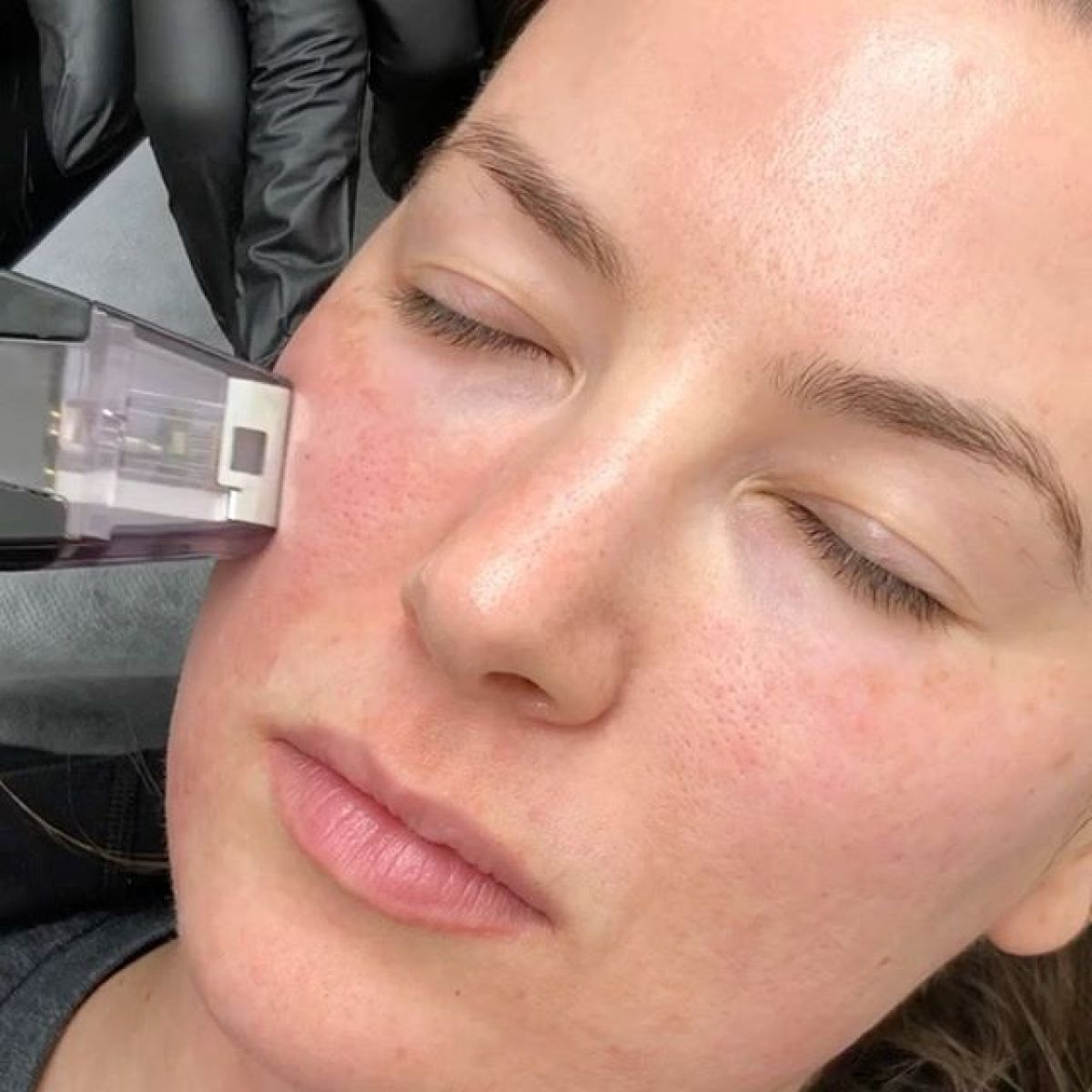 MicroNeedling BB Glow à Saint-Médard-en-Jalles (33) Par Mélody - Estheca
