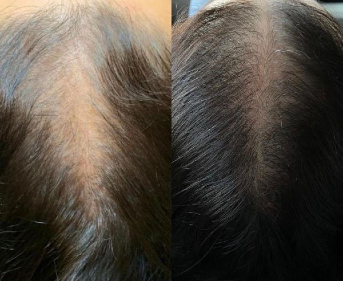 Mesotherapie cheveux à Bordeaux (33) Par Rokaya - Estheca