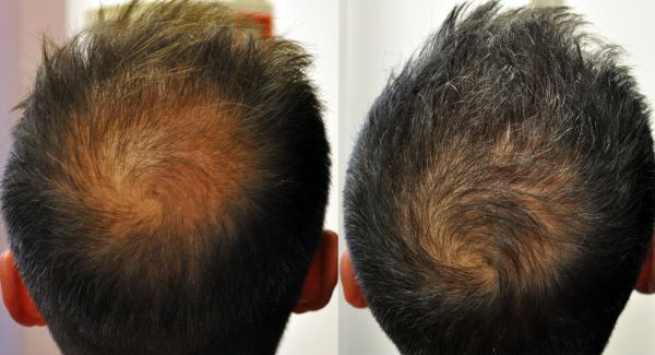 À Noisy-le-Grand | Meso Hair | Les meilleures esthéticiennes