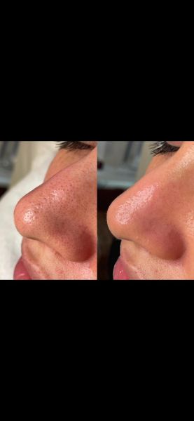 À Lattes | Hydrafacial (Acné, points noirs...) | Les meilleures esthéticiennes