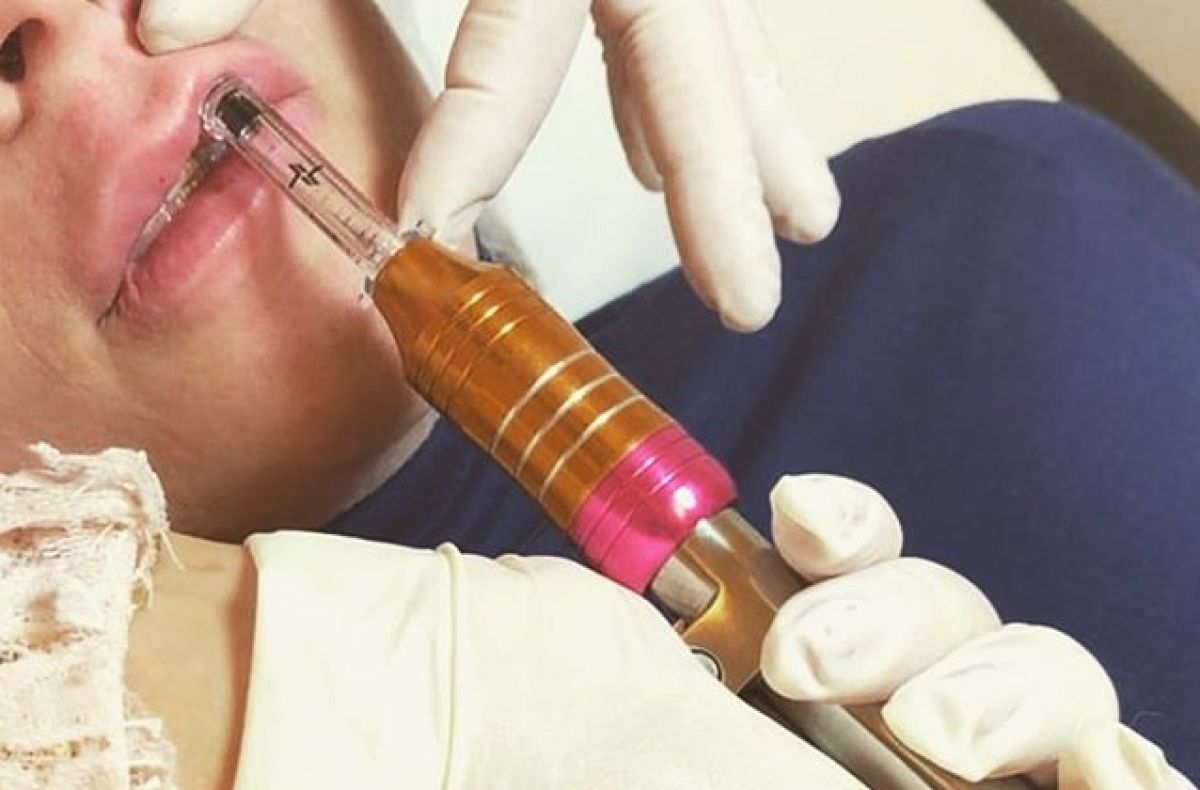 Hyaluron pen Lèvres à Miramas (13) Par Melina - Estheca