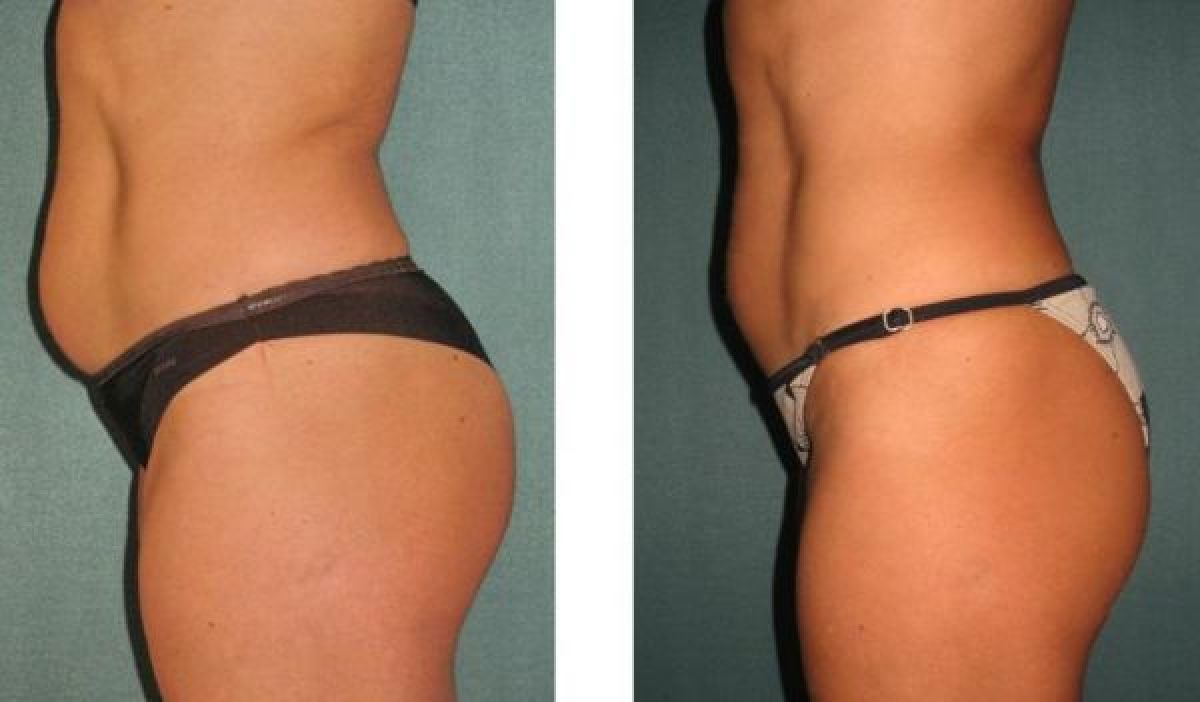 Radio fréquence / Lipocavitation à Bron (69) Par Caroline - Estheca