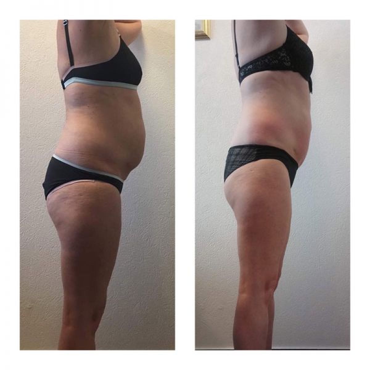 Radio fréquence - Lipocavitation à Laxou (54) Par Célia - Estheca