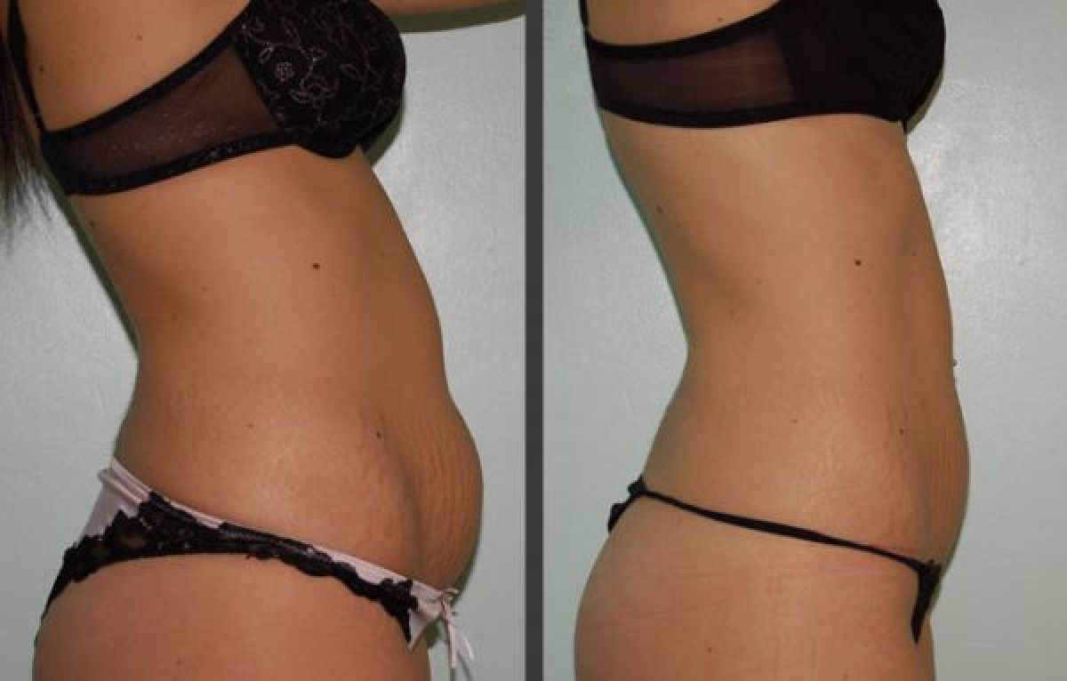 Radio fréquence / Lipocavitation à L'Union (31) Par Inès - Estheca