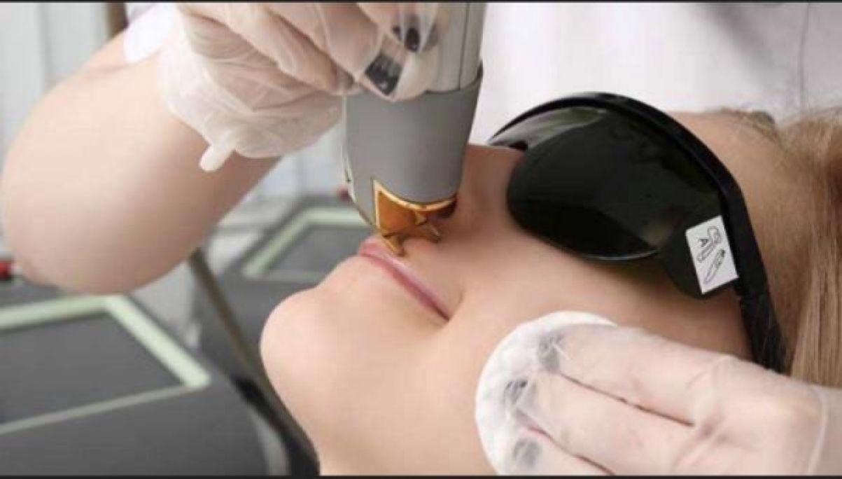 Épilation par lumière pulsée à Marseille (13) Par Cynthia - Estheca