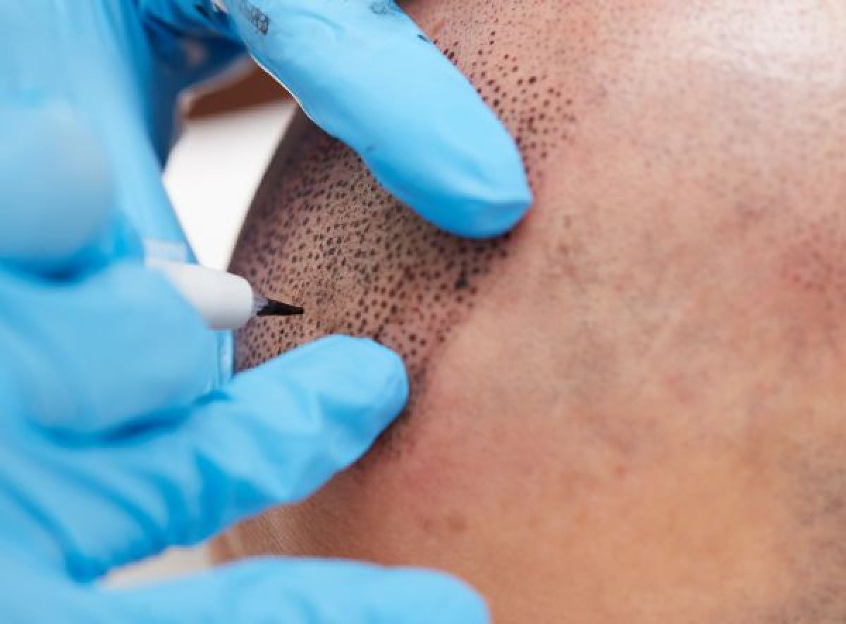 Tricopigmentation du cuir chevelu à Antibes (06) Par Rachelle - Estheca