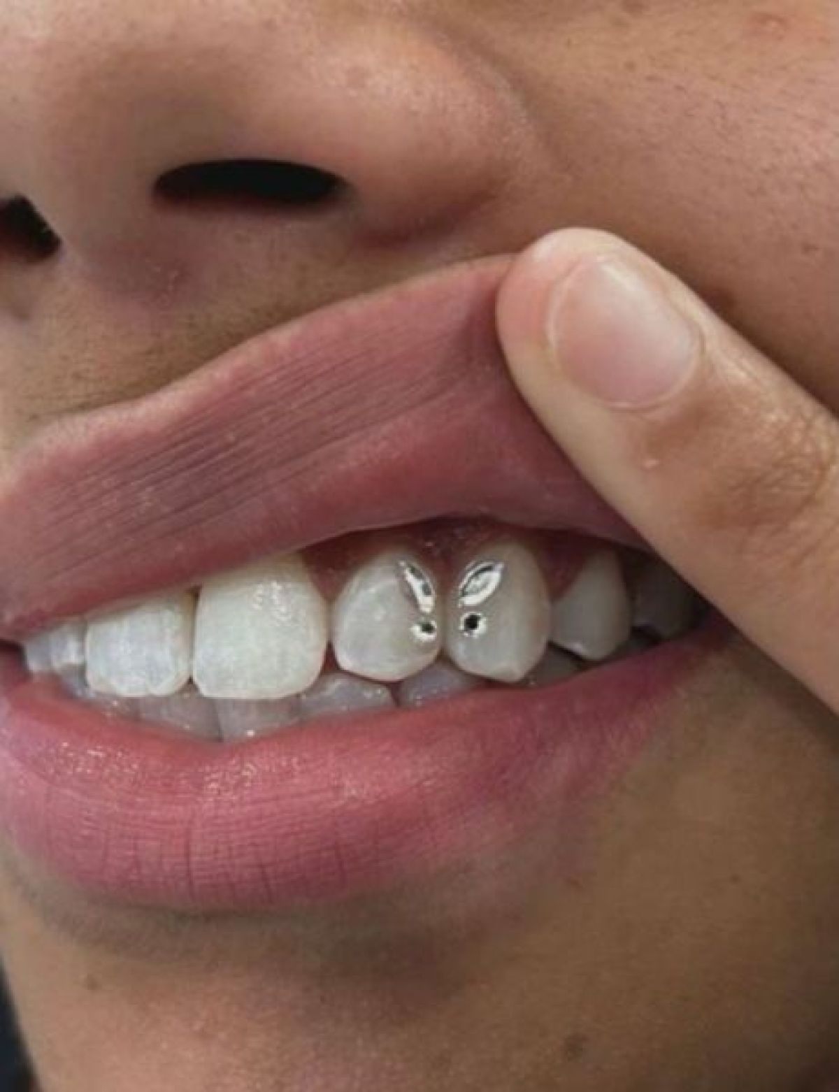 Strass dentaire à Rennes (35) Par Estelle - Estheca