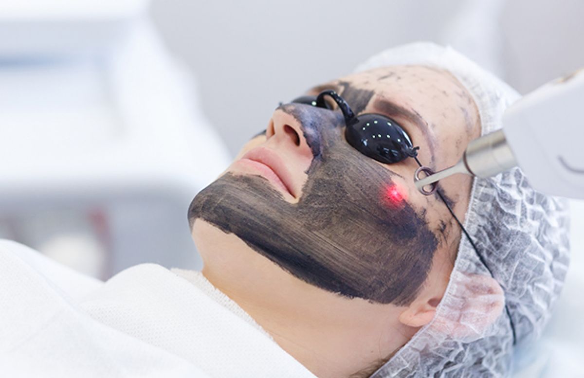 Carbone Laser Peel  à Amiens (80) Par Reina - Estheca