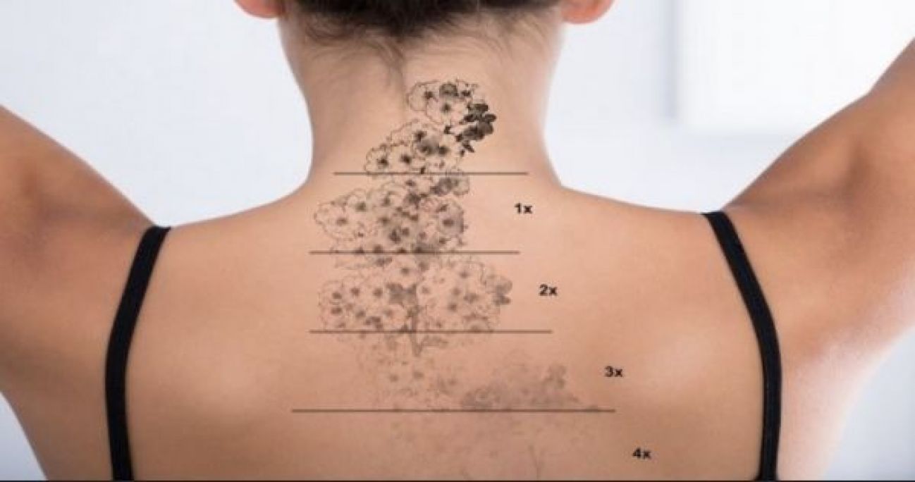 Détatouage et depigmentation express à Reims (51) Par Inès - Estheca