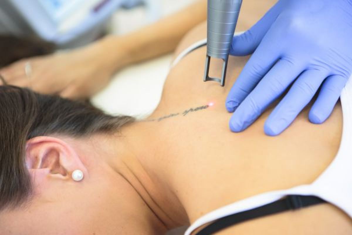 Détatouage laser à Nice (06) Par Bruna - Estheca