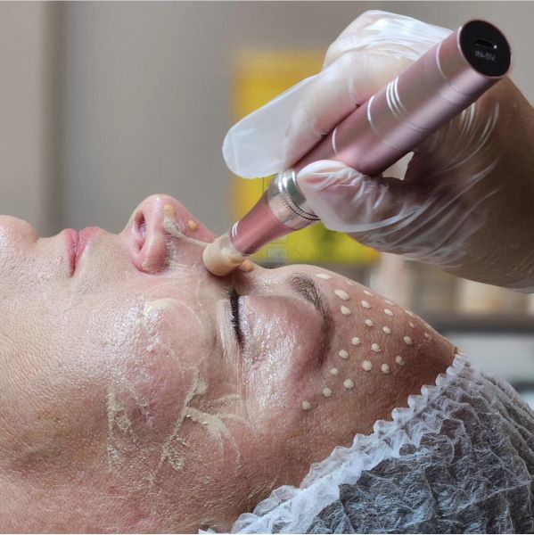 À Rouen | Microneedling / BB GLOW | Les meilleures esthéticiennes