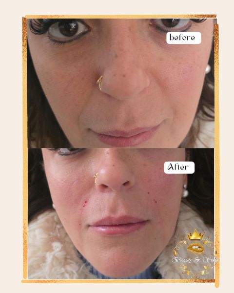 À Paris | Formation augmentation de volume visage et lèvres sans injections | Les meilleures esthéticiennes