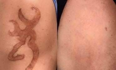 À Amiens | Détatouage picosure | Les meilleures esthéticiennes