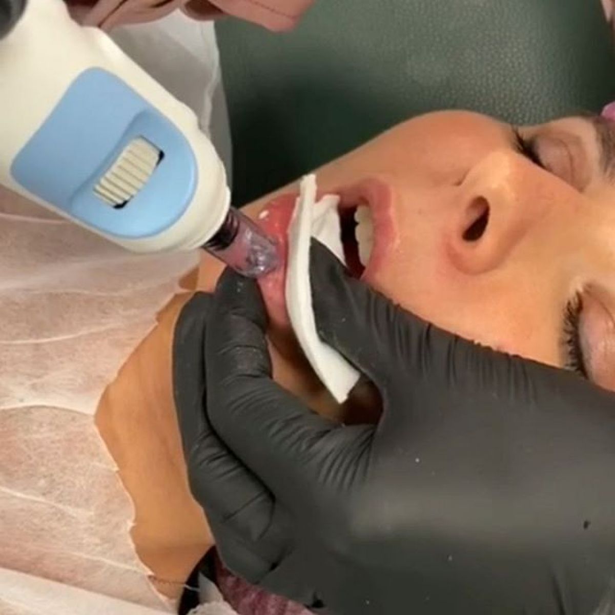 Hyaluron pen lèvres et rides à Boulogne-Billancourt (92) Par Vanessa - Estheca