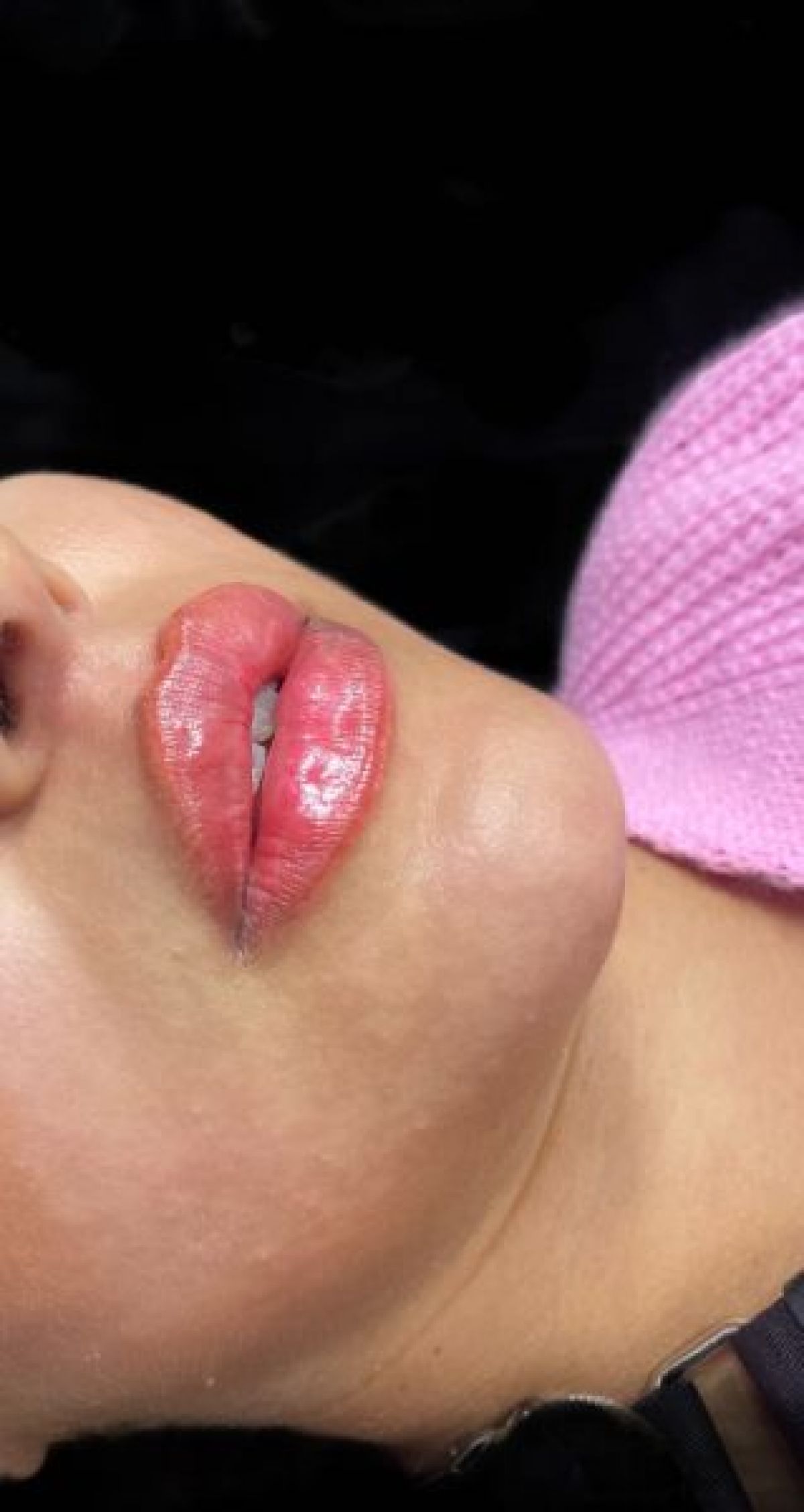 Augmentation des lèvres / Russian lips à Décines-Charpieu (69) Par Cherihanne - Estheca