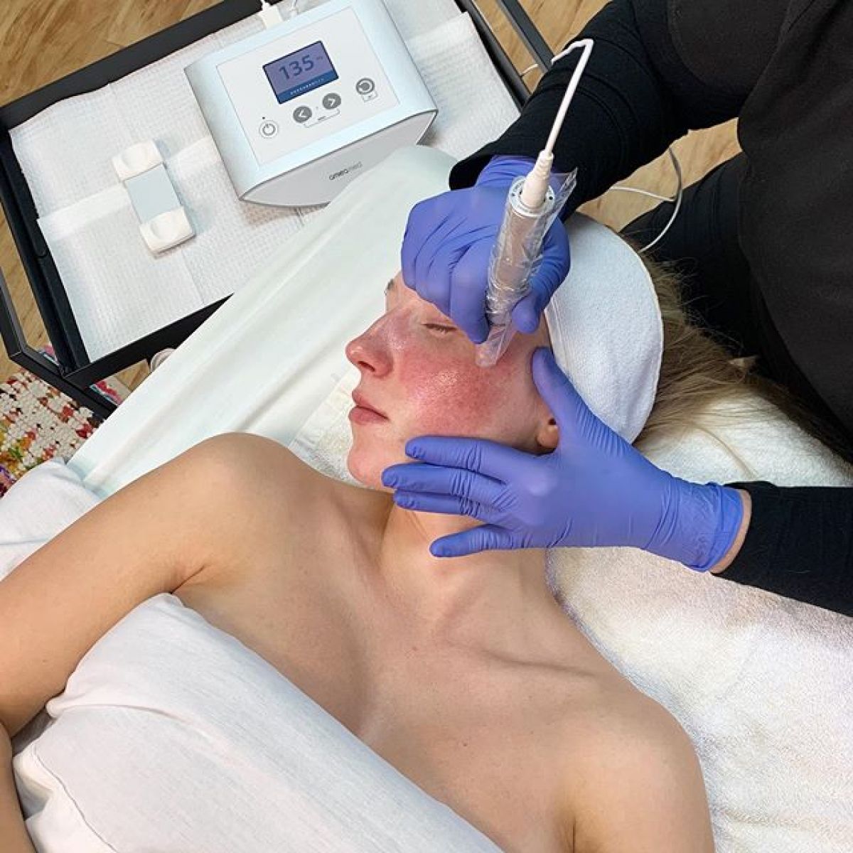 MicroNeedling BB Glow à Meyzieu (69) Par Manon - Estheca
