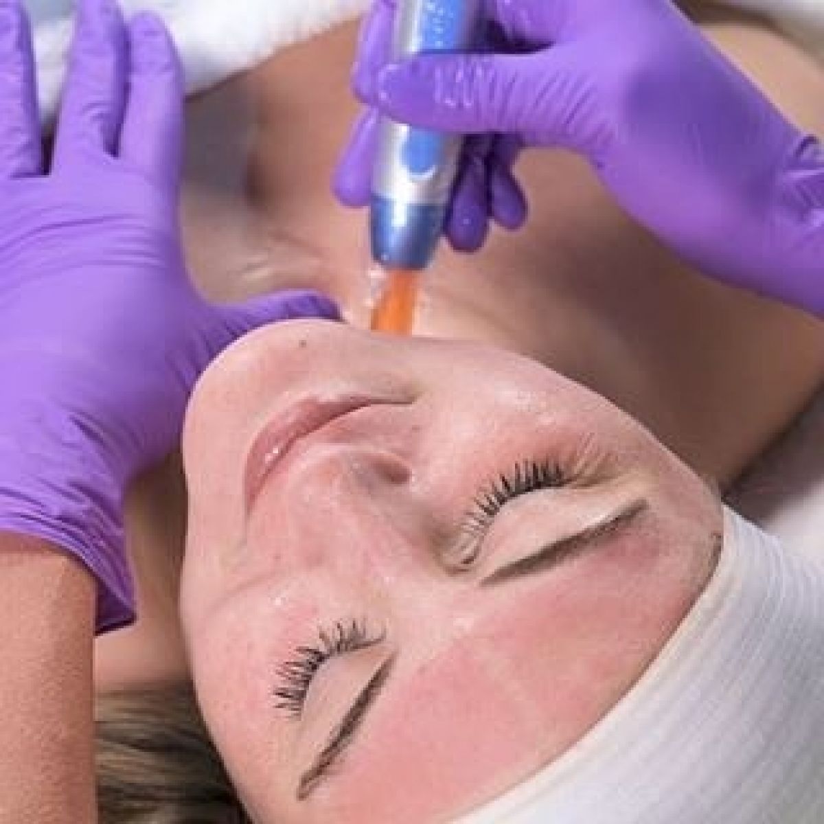 MicroNeedling BB Glow à Melun (77) Par Emmanuelle - Estheca