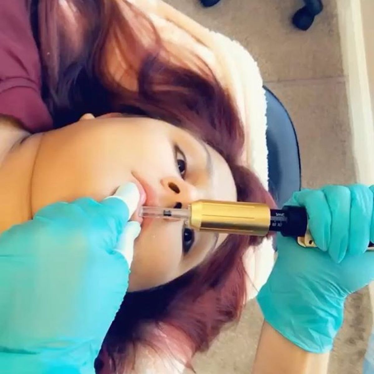 Hyaluron pen Lèvres à Tournefeuille (31) Par Manon - Estheca