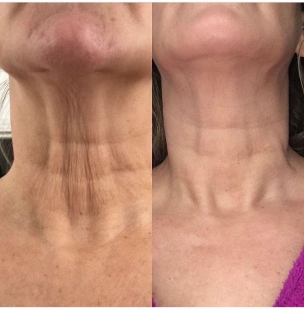Plasma pen/lift à Marans (17) Par Françoise - Estheca