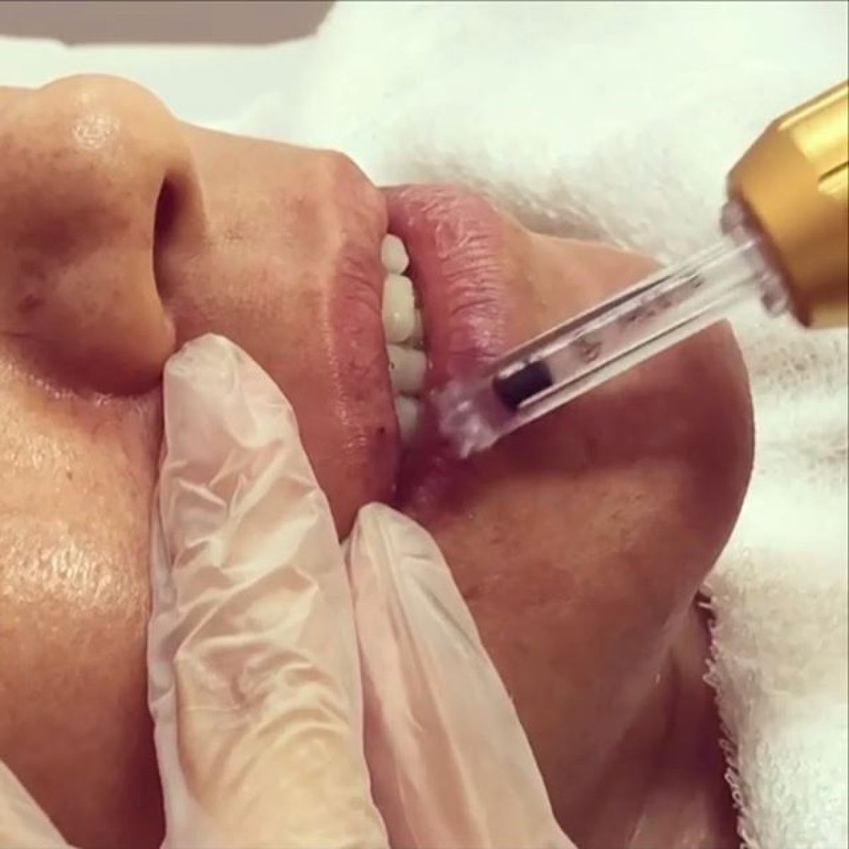 Hyaluron pen Lèvres à Argenteuil (95) Par Audrey - Estheca