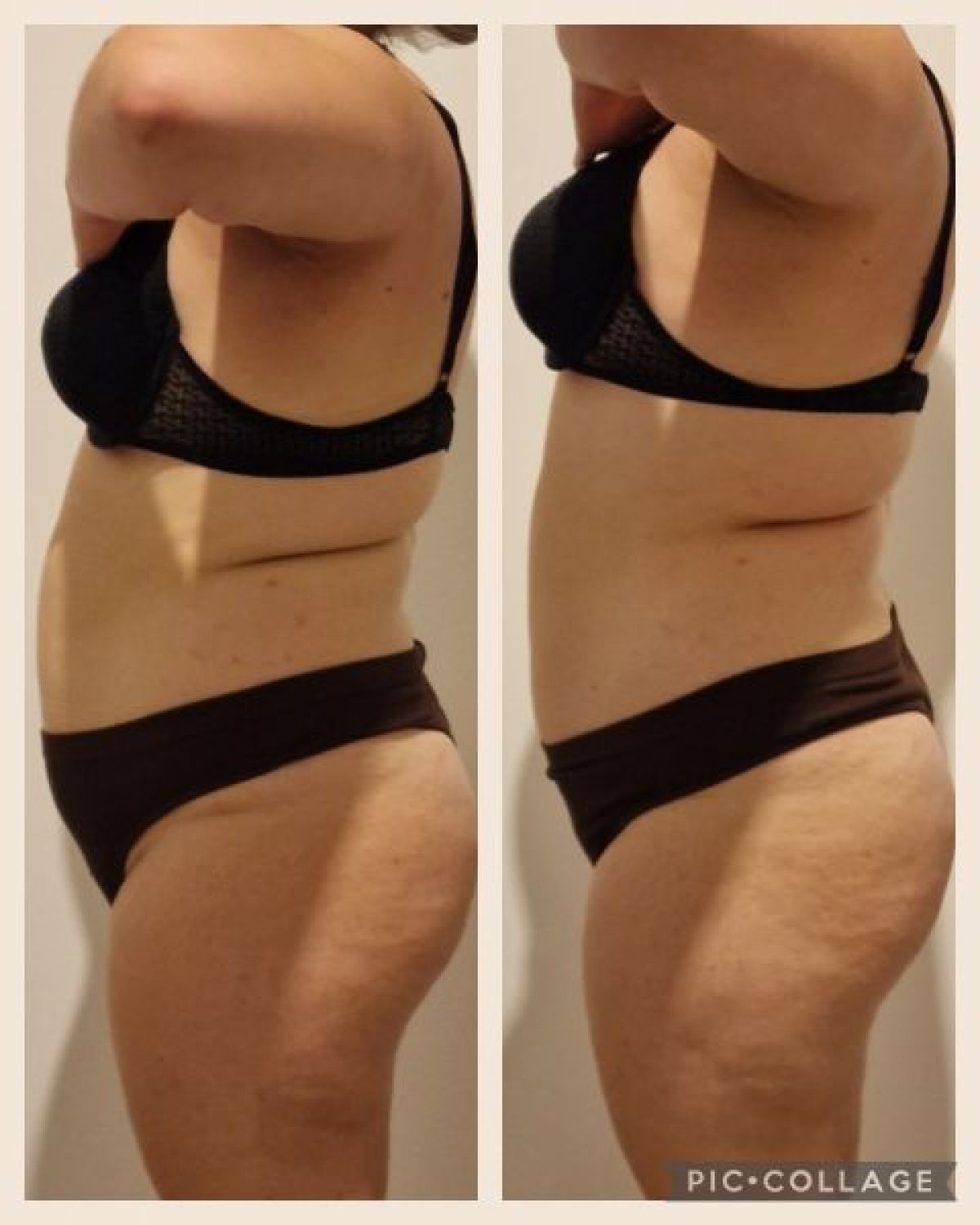 Lipocavitation / Radiofréquence  à Dammartin-en-Goële (77) Par Veronique - Estheca