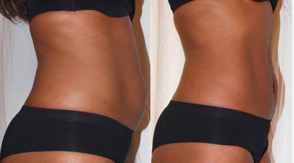 À Le Moule | Lipocavitation/ Radiofréquence | Les meilleures esthéticiennes