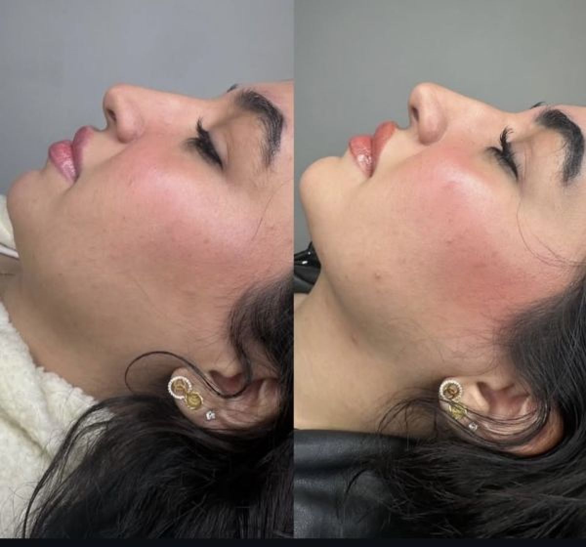 Dissolution de graisse à Cesson-Sévigné (35) Par Gilberte - Estheca