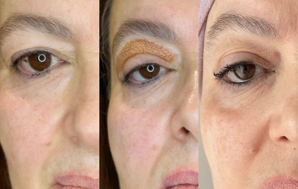 À Paris | Jett Plasma lift - lifting sans Chirurgie -  | Les meilleures esthéticiennes