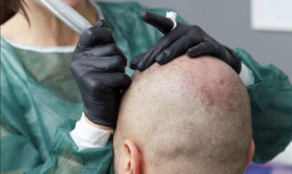 À Bouzonville | Tricopigmentation du cuir chevelu | Les meilleures esthéticiennes