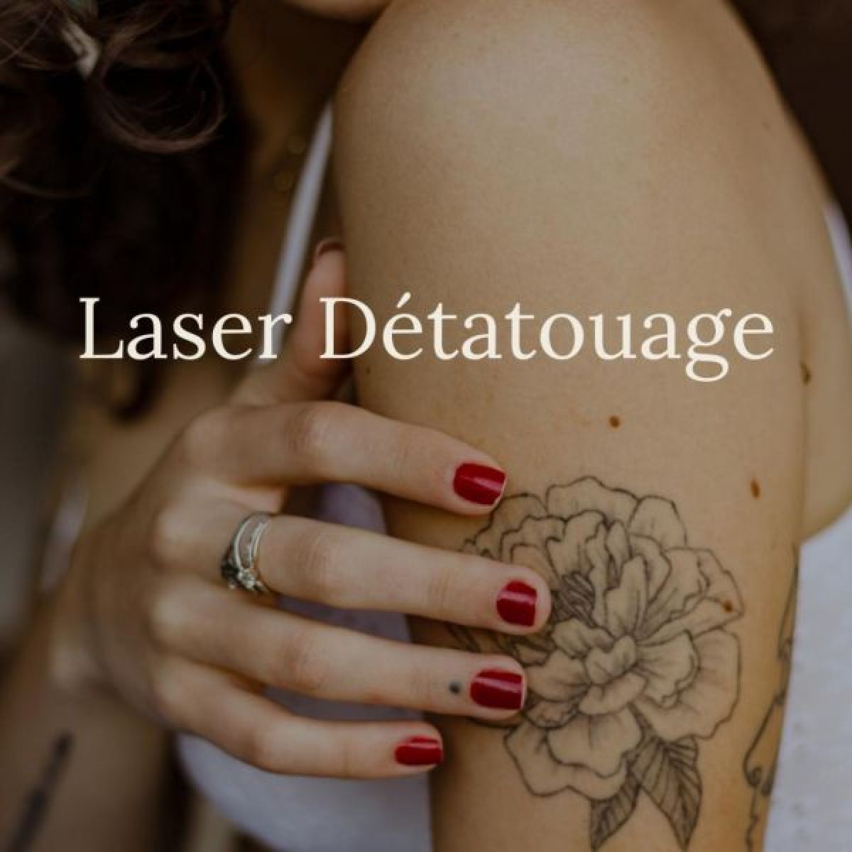 Détatouage Laser Pico à Guénange (57) Par Magalie - Estheca