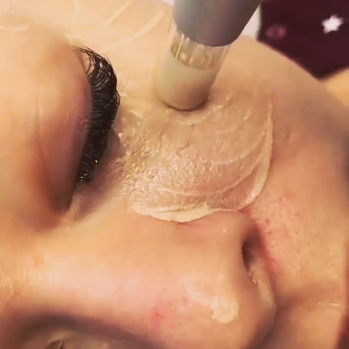 MicroNeedling BB Glow à Castanet-Tolosan (31) Par Gwendoline - Estheca