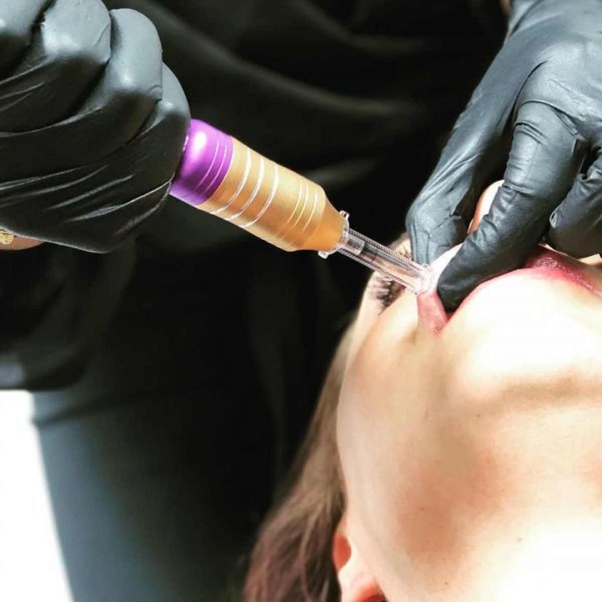 Hyaluron pen à Vence (06) Par Marion - Estheca