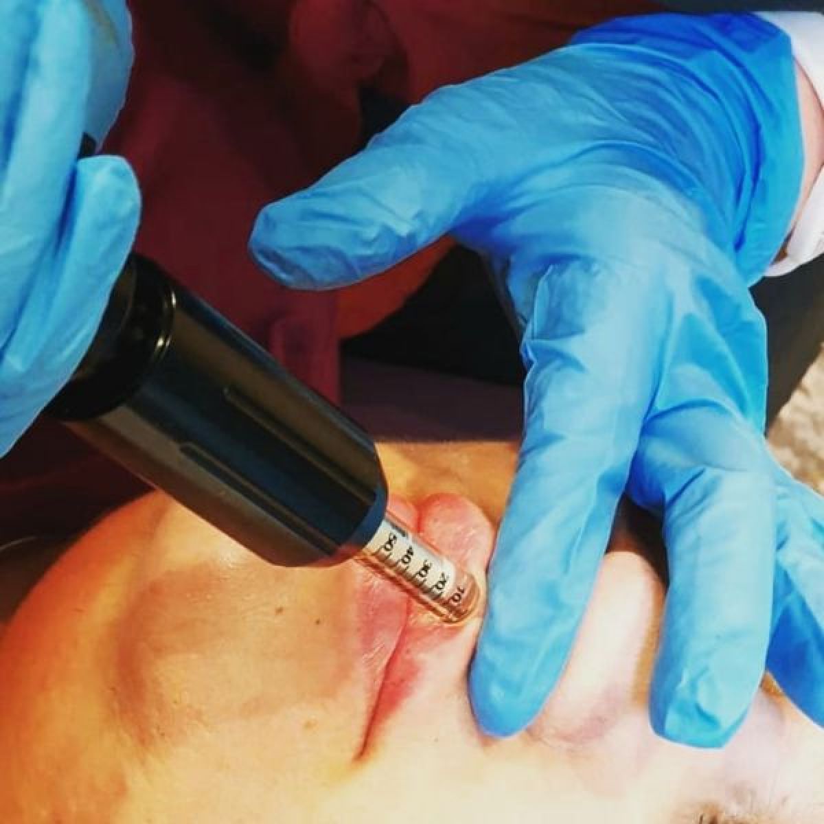 Hyaluron pen lèvres et rides à Eckbolsheim (67) Par Sandrine - Estheca