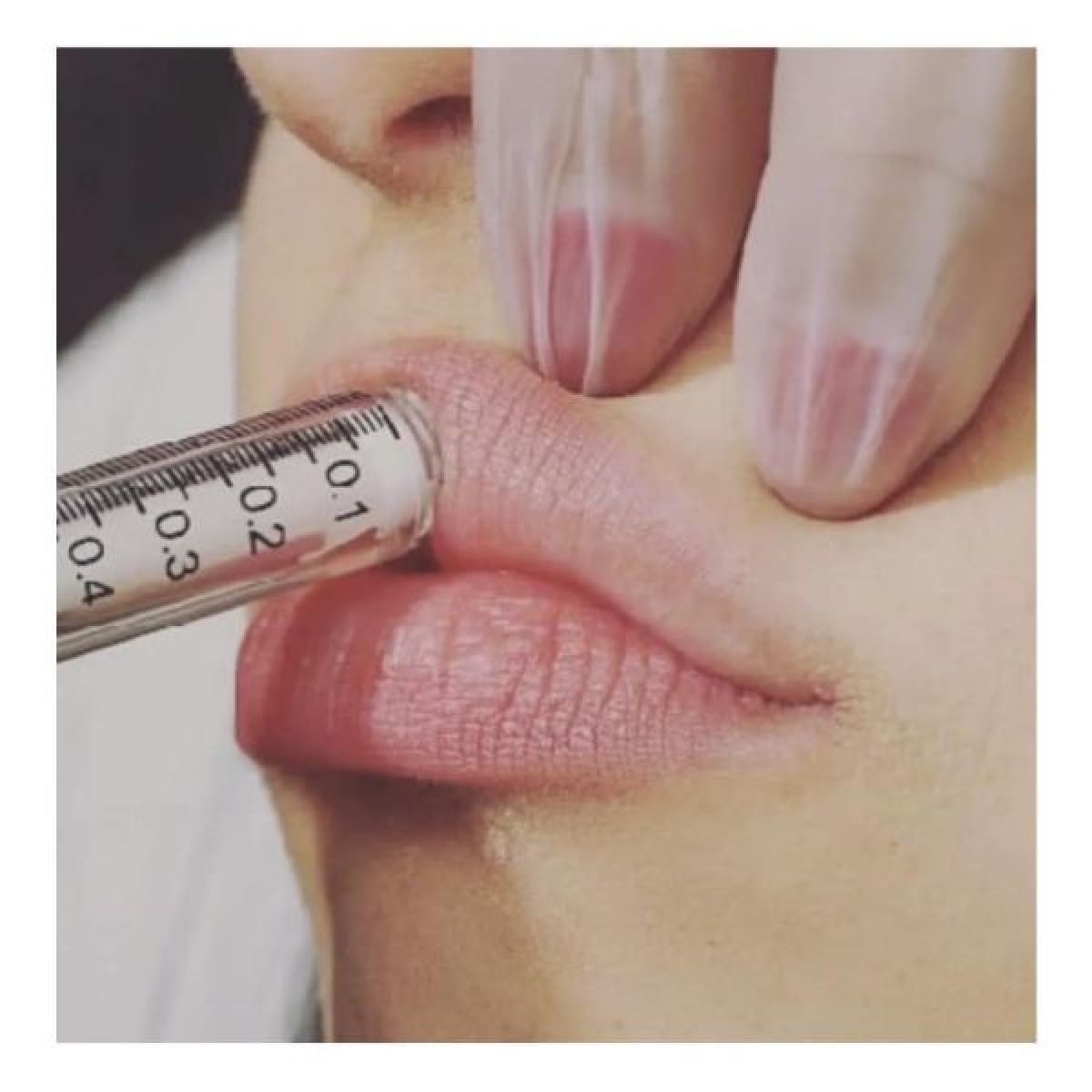 Augmentation des lèvres à Roubaix (59) Par Mélodie - Estheca