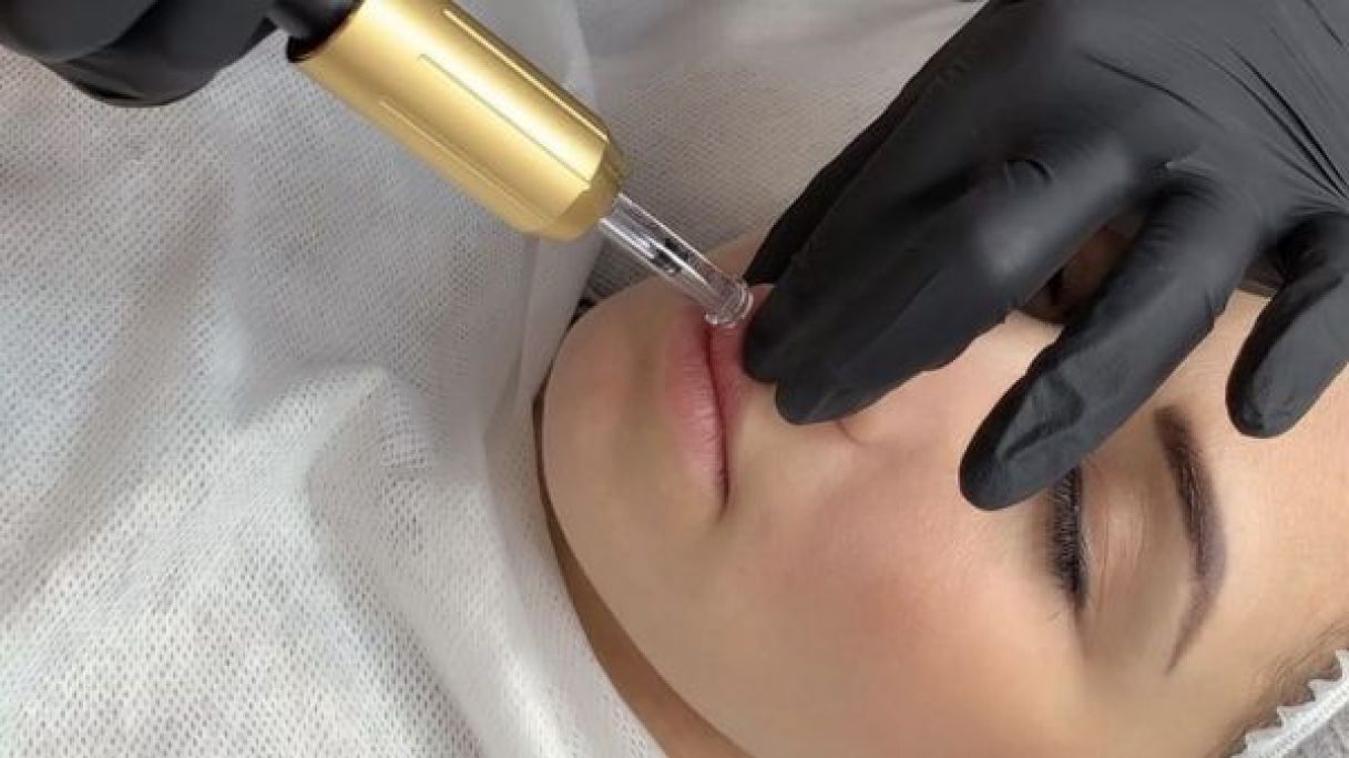 Augmentation des lèvres par Hyaluron Pen à Venelles (13) Par Mélanie - Estheca