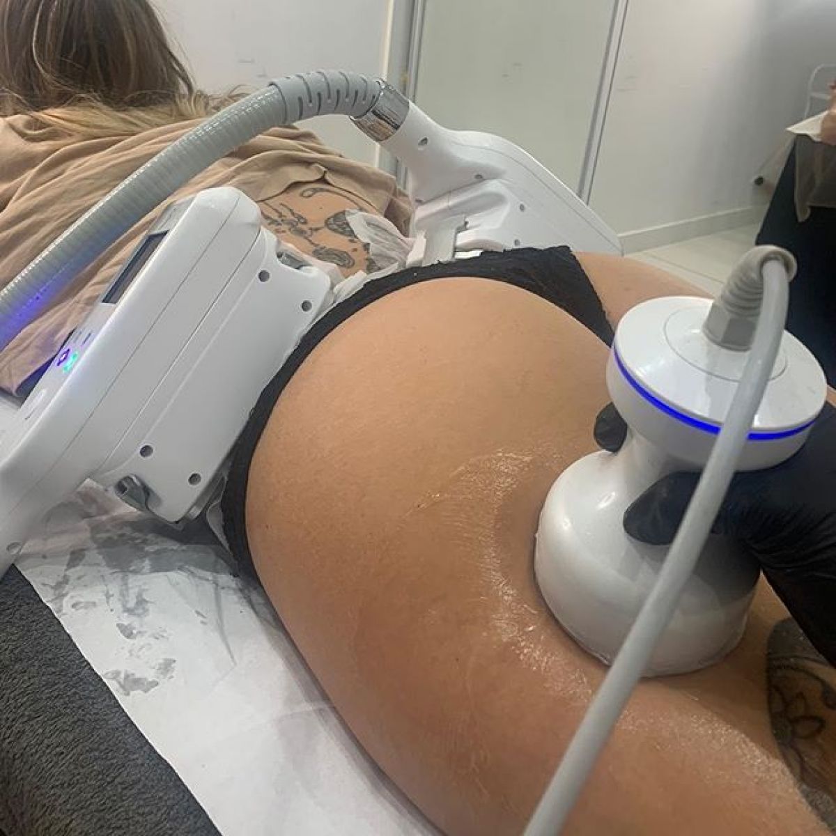 Radio fréquence et Lipocavitation à Cergy (95) Par Melinda - Estheca