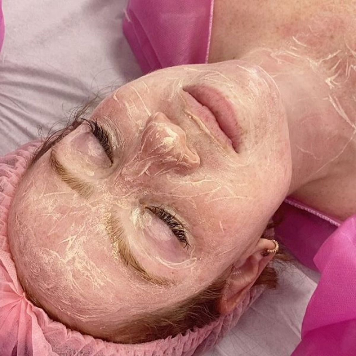 MicroNeedling BB Glow à Talence (33) Par Virginie - Estheca