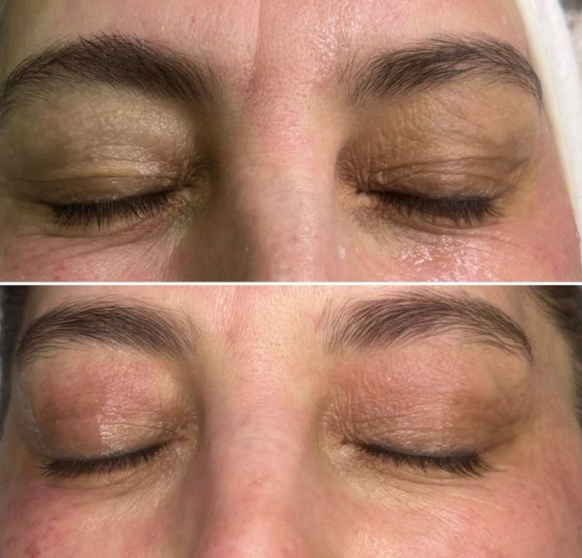 Plasma Froid Russe ( ARC SYSTEME) à Massy (91) Par Samya - Estheca