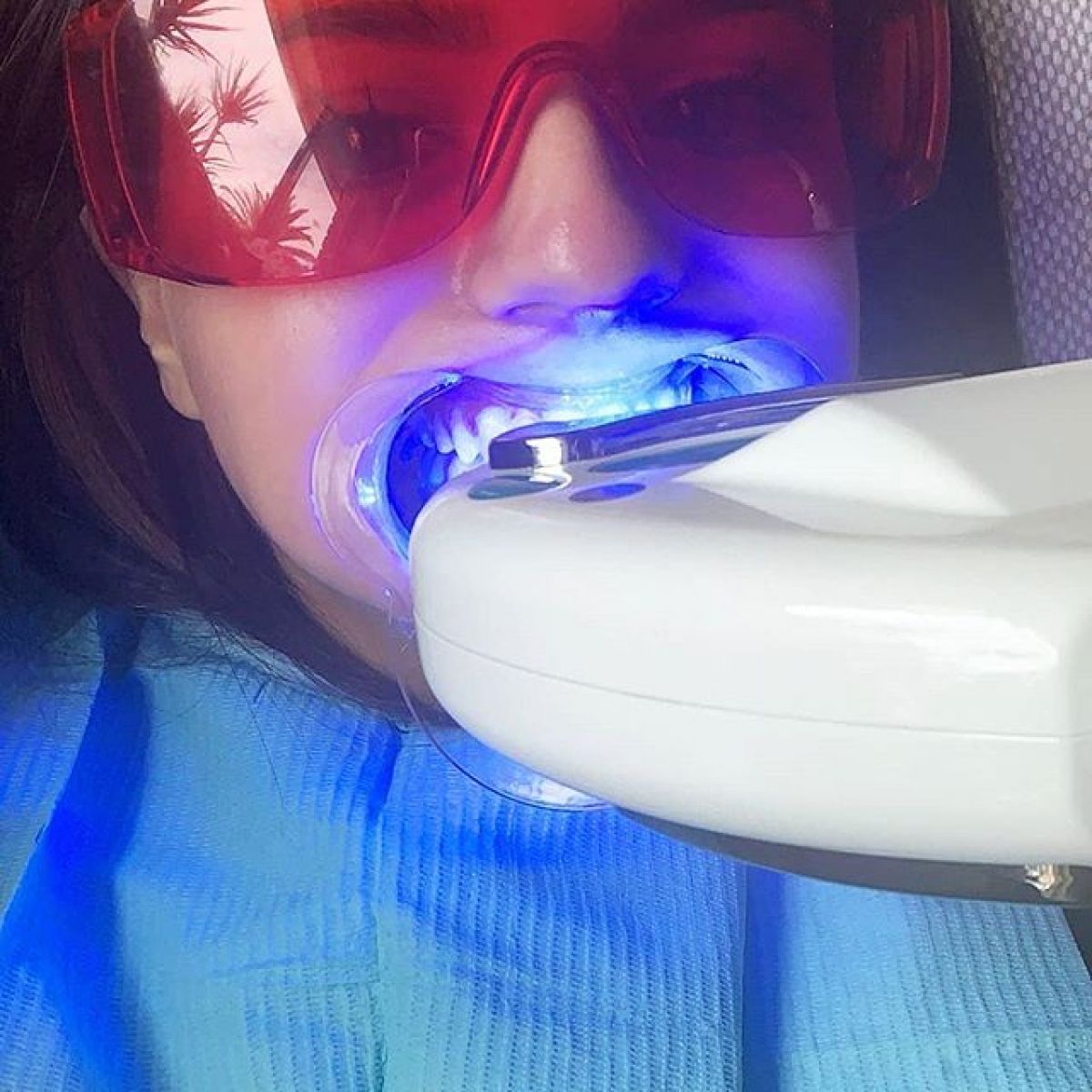 Blanchiment dentaire Pro à Villeurbanne (69) Par Cassandra - Estheca