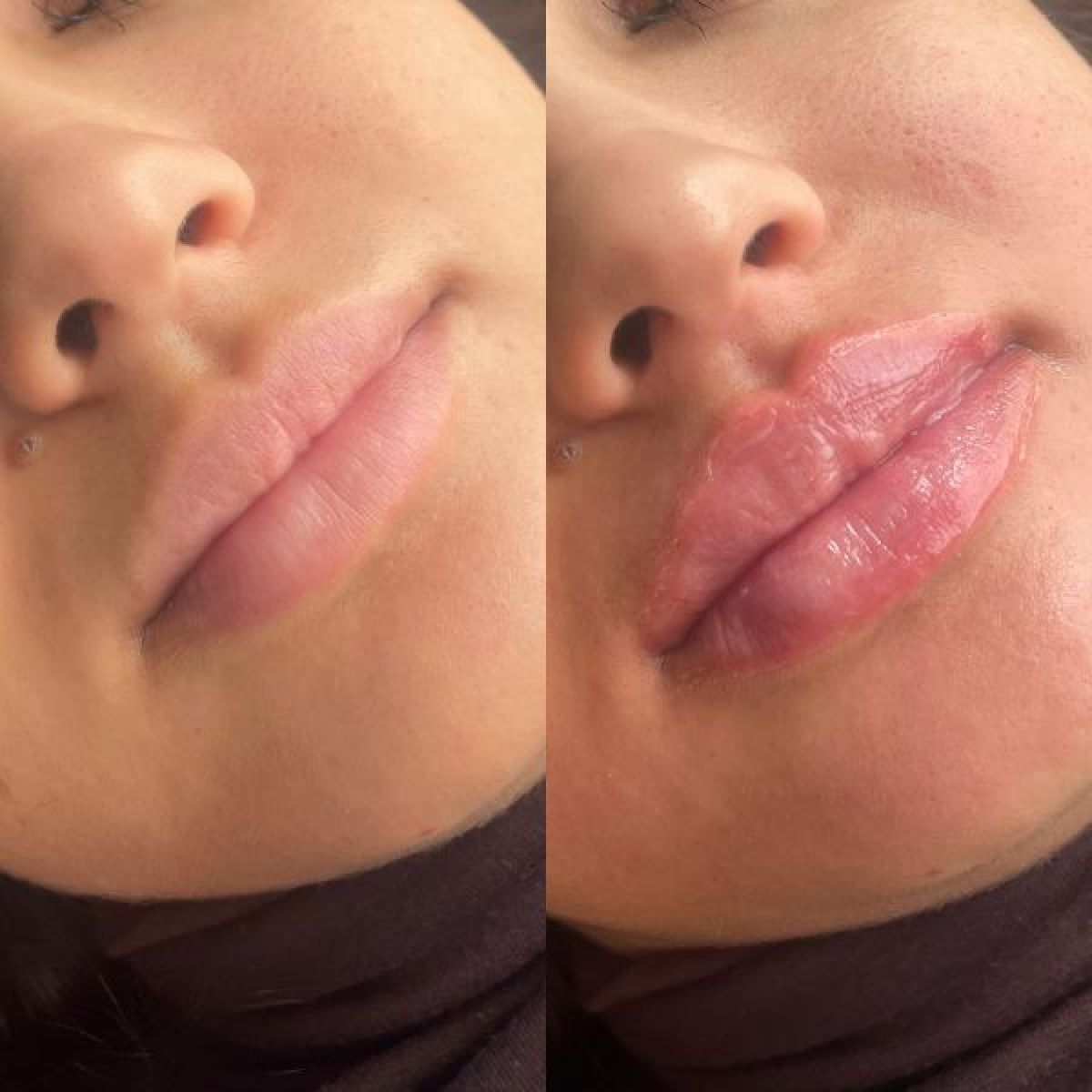 Russian lips / Augmentation des lèvres à Tours (37) Par Anaïss - Estheca