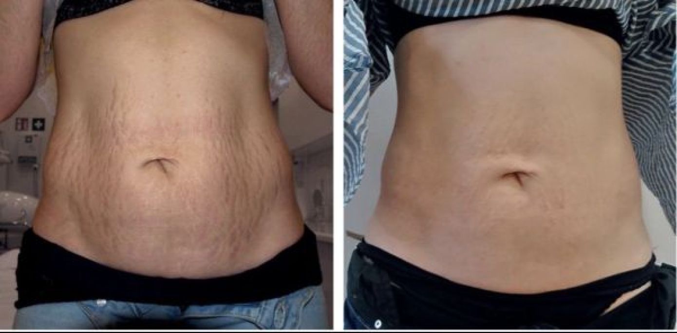 Peeling vergetures, anti-âge ,anti-acné à Tourcoing (59) Par Fatima - Estheca