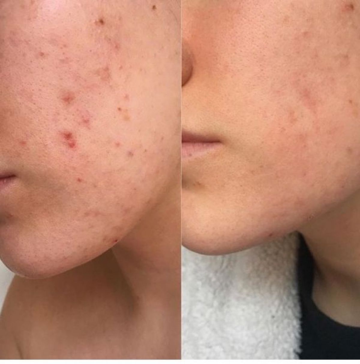 Microneedling / BB glow à Loos (59) Par Imene - Estheca