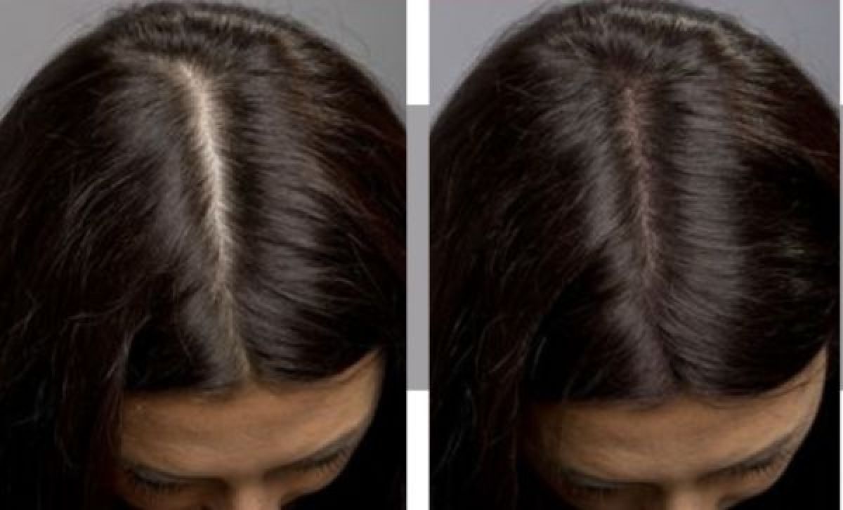 Prp soin visage à Toulouse (31) Par Rania - Estheca