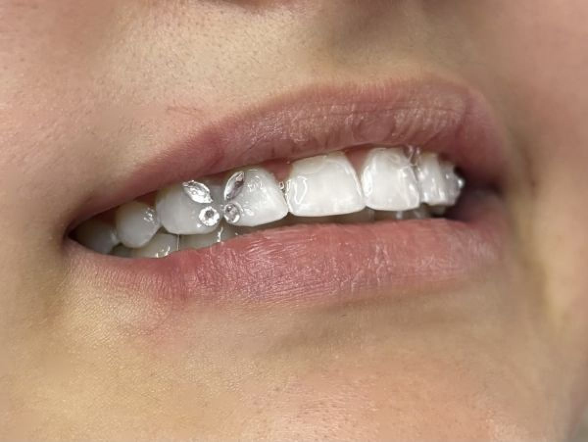 Strass dentaire à Toulouse (31) Par Alexandra - Estheca
