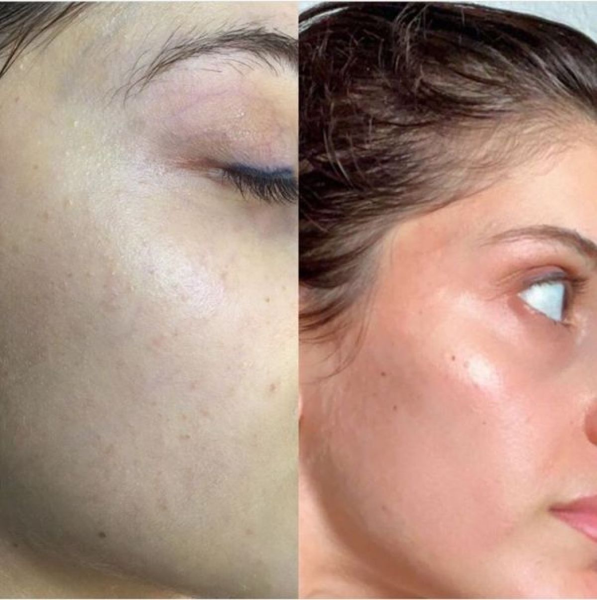 Microneedling BB GLOW à Nangis (77) Par Sabah - Estheca