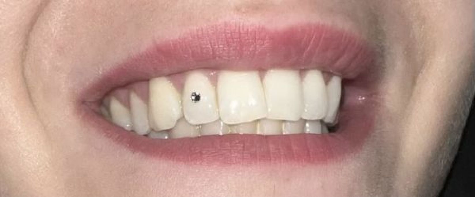 Strass dentaire à Mantes-la-Ville (78) Par Rubina - Estheca