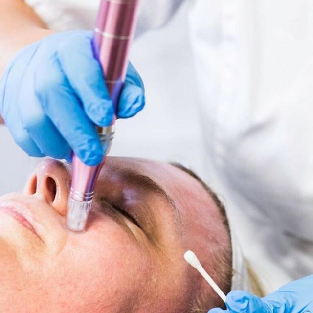 À Nice | Microneedling | Les meilleures esthéticiennes
