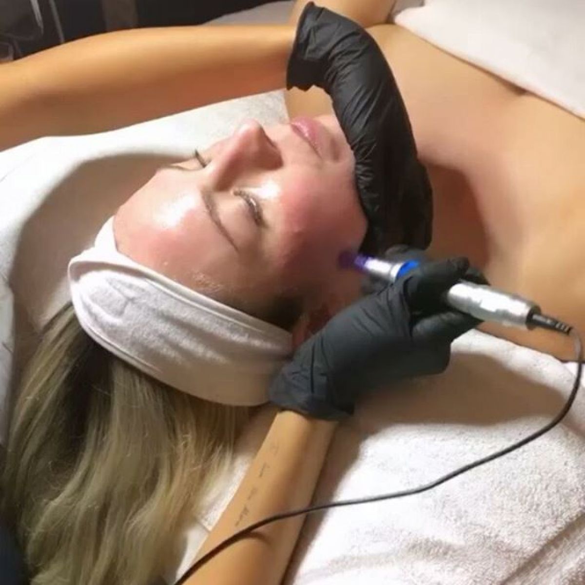 MicroNeedling BB Glow à Neuilly-sur-Seine (92) Par Aurélie - Estheca